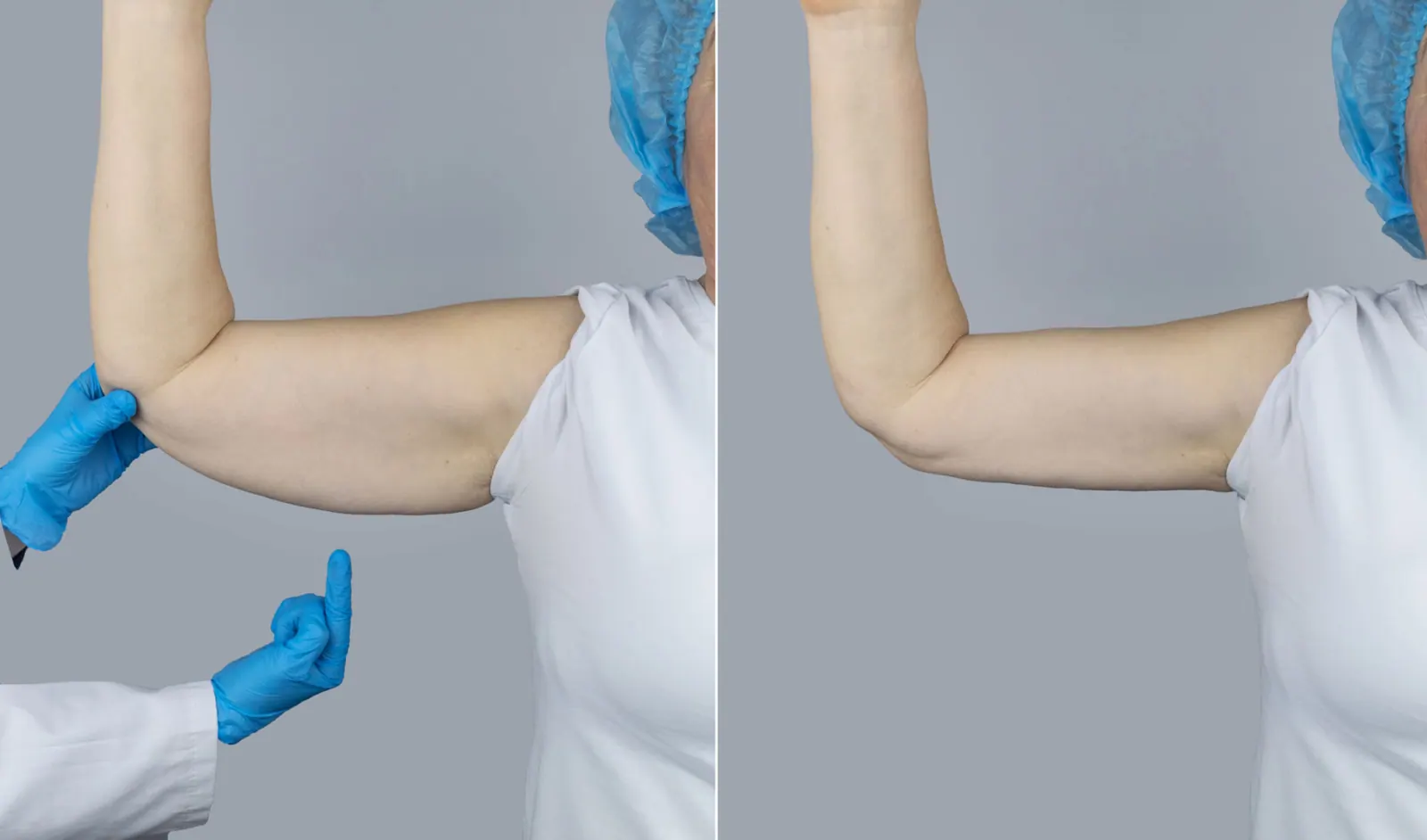 Brachioplasty