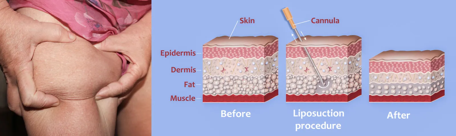 Body contouring and liposuction concept — targeted fat reduction.