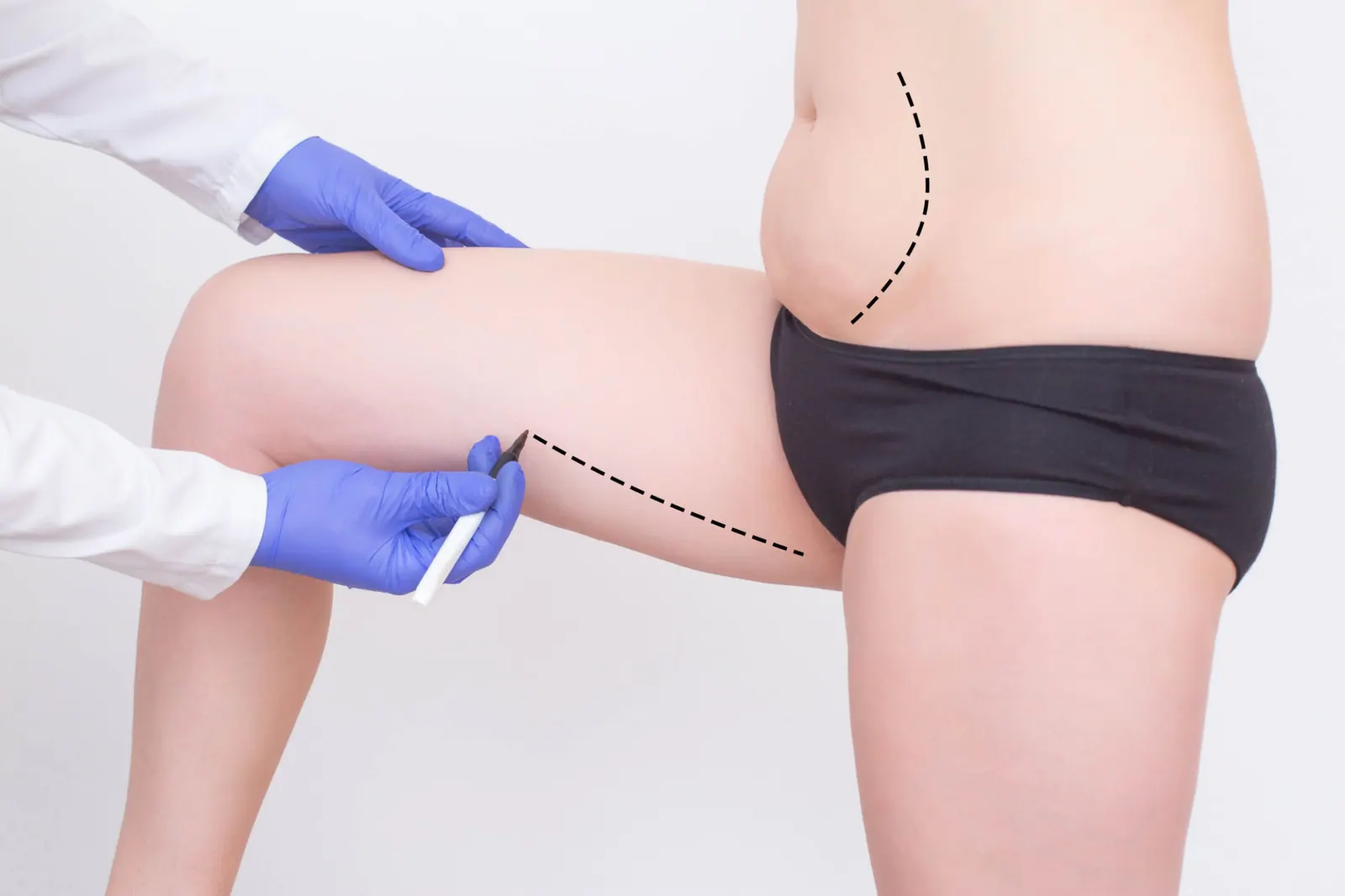 Thigh Lift