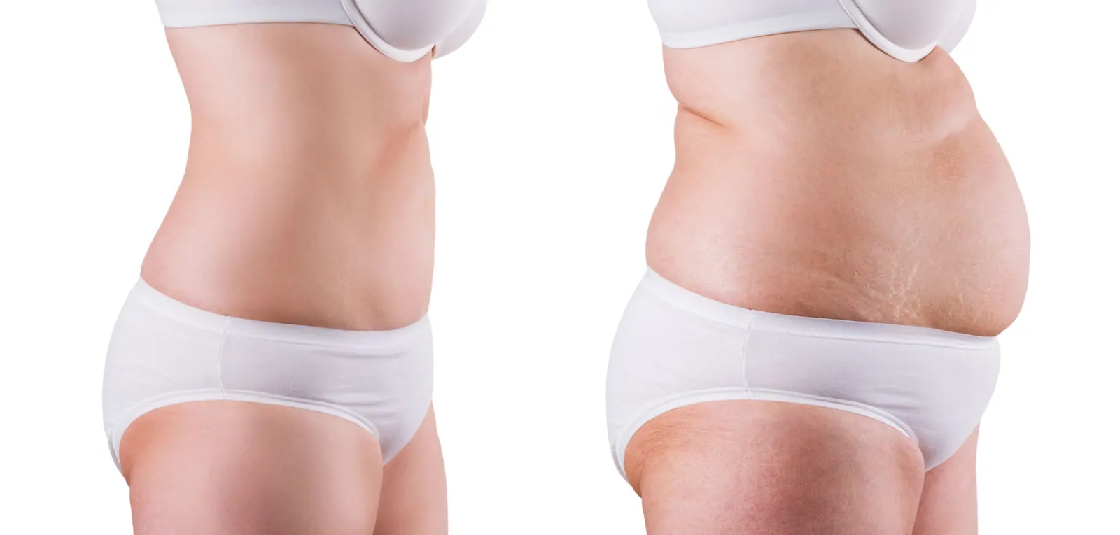 Abdominal contouring — tummy tuck (abdominoplasty) overview.