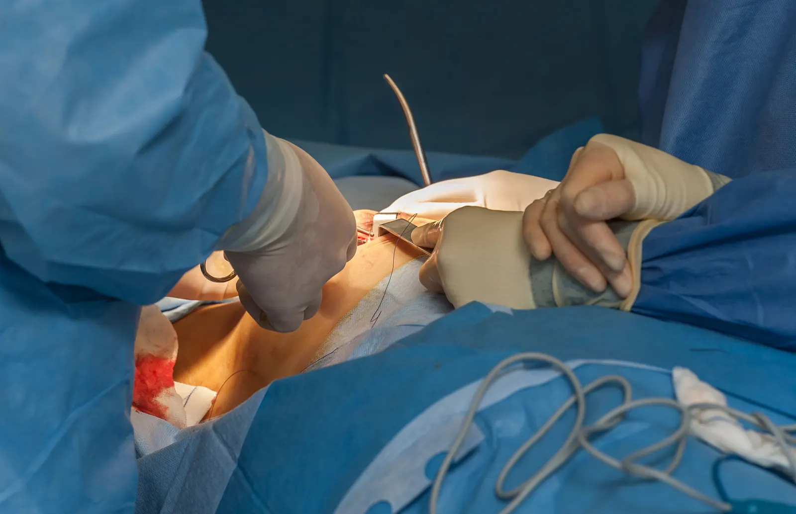 Breast Reduction