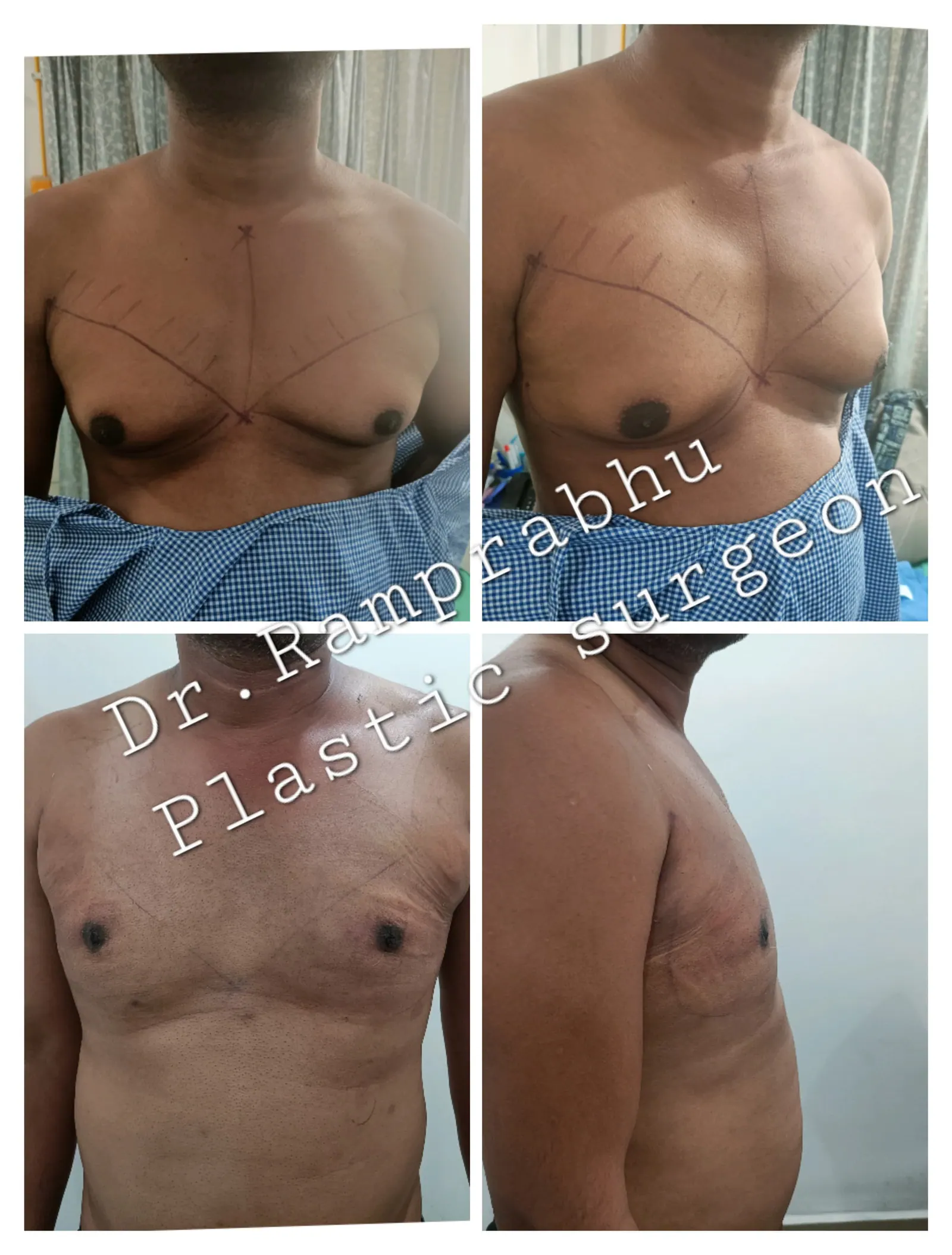 Before and After Results