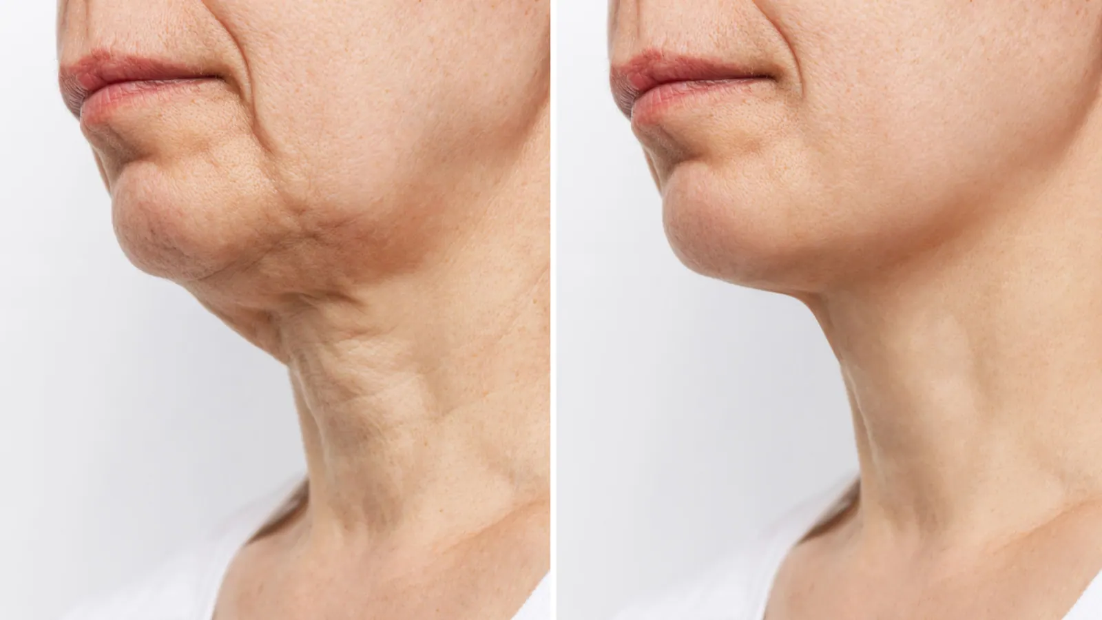 Neck Lift