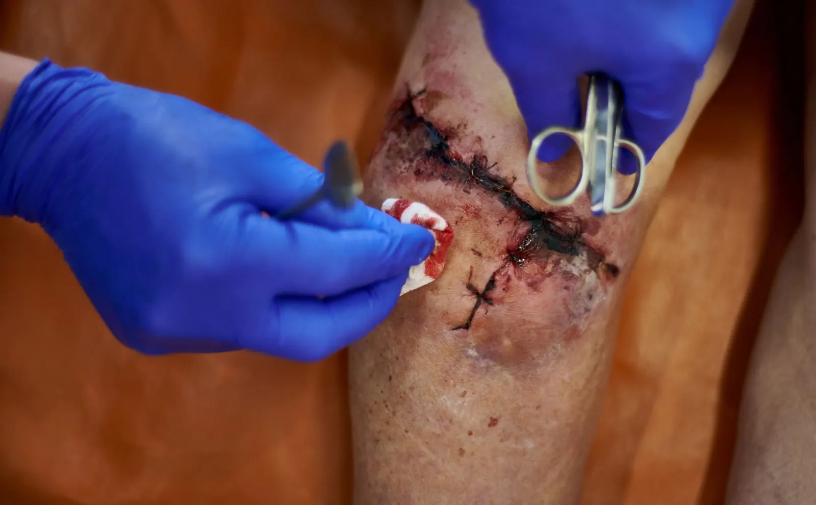 Reconstructive surgery for complex wounds and diabetic foot complications.