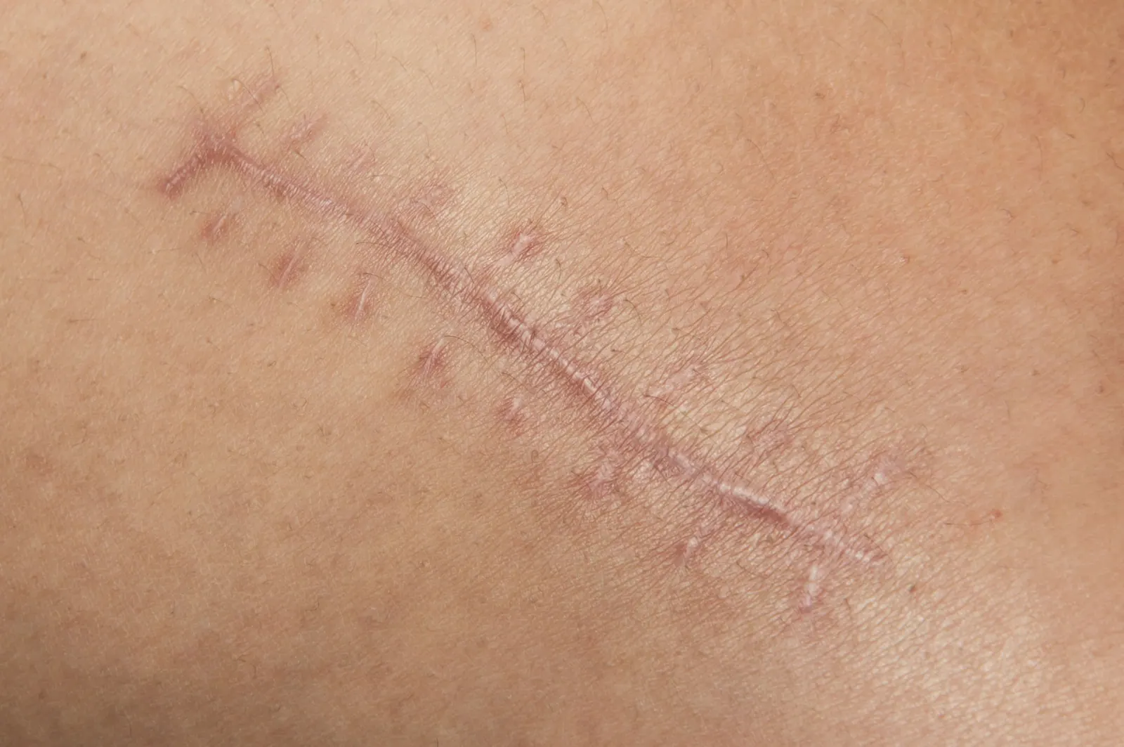Scar Revision