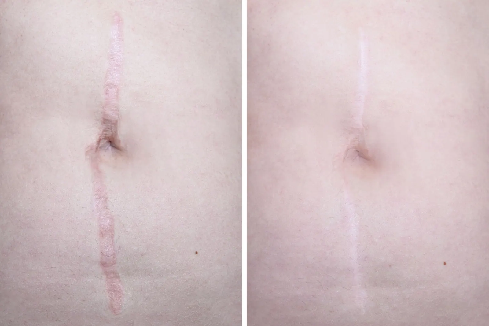 Before and After Results