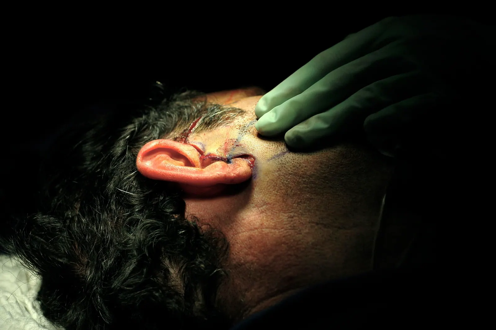 Congenital Reconstruction